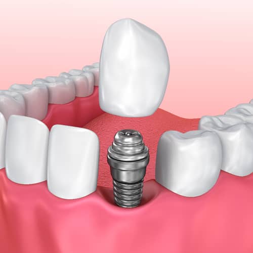 Dental Implants Chelmsford Single Tooth Dental Implants Essex